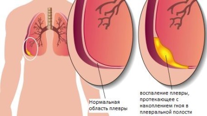 Simptomele și tratamentul pleureziei uscate, diferența de pleurezie exudativă