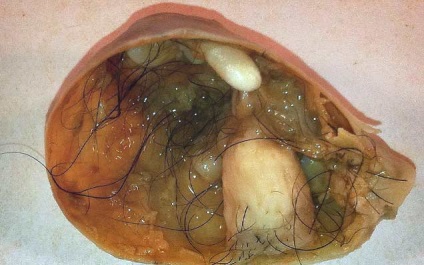 Teratomul simptomelor ovariene, imaginile, modul de tratare, prognosticul