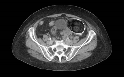 Teratomul simptomelor ovariene, imaginile, modul de tratare, prognosticul
