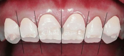 Тетрацікліовие зуби - терапія, як швидко відбілити зуби