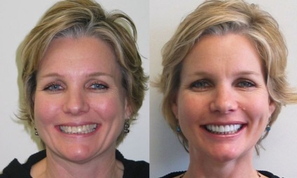 Terapia cu dinți tetradiclinici - terapie, cât de repede se albifiază dinții