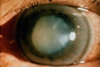 Тунельний зір причини звуження полів зору у чоловіків