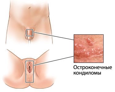 Видалення кондилом на інтимних місцях