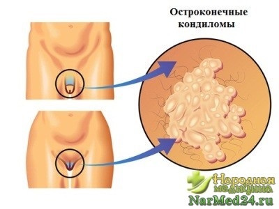 Видалення кондилом на інтимних місцях