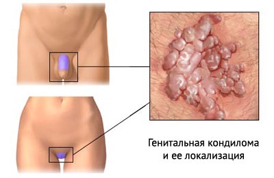 Видалення кондилом на інтимних місцях