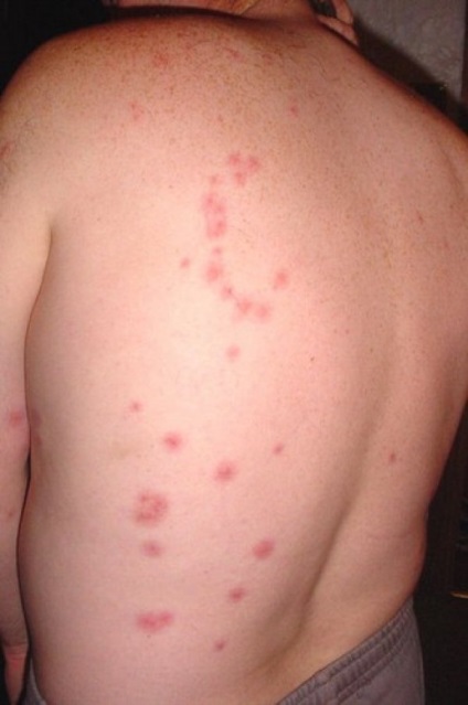 Bite de purici pe o persoană sunt tratate și eliminate simptome, precum și fotografii pe corp