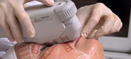 Ridicarea cu ultrasunete a feței - ridicarea smasului