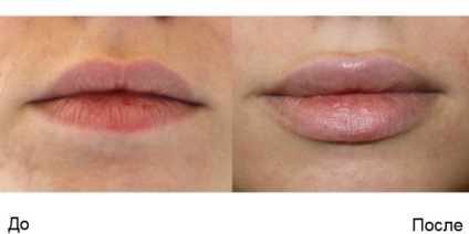 Îmbunătățirea buzelor cu revizuiri ale acidului hialuronic, contraindicații și recomandări ale specialiștilor