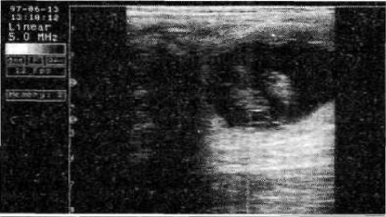 Ultrahang (ultrahang) Diagnózis terhesség