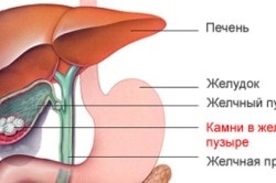 Ulcerul vezicii biliare cu definiție a funcției