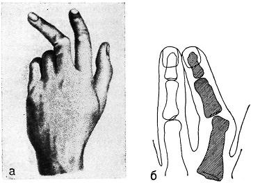Вивихи фаланг пальців причини, наслідки, методи лікування
