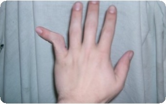 Вивихи фаланг пальців причини, наслідки, методи лікування