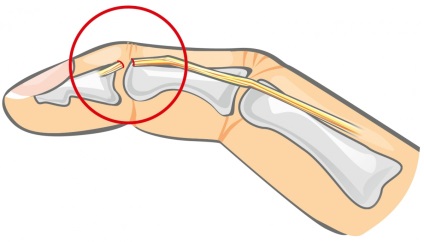 Dislocarea falangelor cauzelor de degete, consecințe, metode de tratament