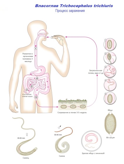 Власоглав у людини життєвий цикл, будова, симптоми, лікування