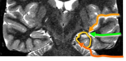 Tratamentul chirurgical al formelor temporale de epilepsie