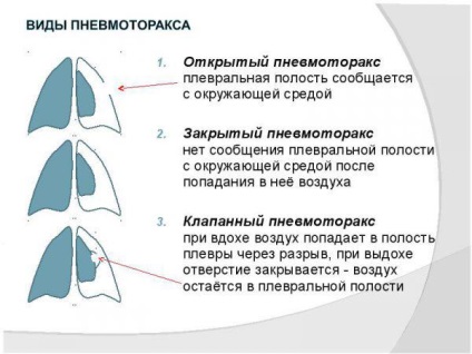 Simptomele Hobl și tratamentul bolii pulmonare obstructive cronice, standarde, exacerbare