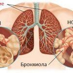 Simptomele Hobl și tratamentul bolii pulmonare obstructive cronice, standarde, exacerbare