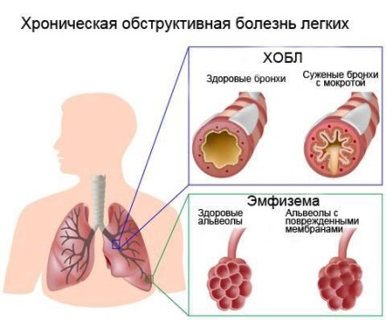 ХОЗЛ симптоми і лікування препаратами хронічної обструктивної хвороби легень, стандарти, загострення