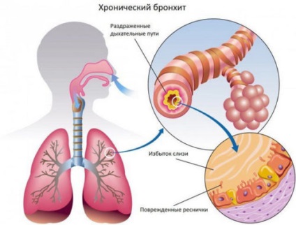 Хронічний бронхіт у дорослих основні препарати для лікування