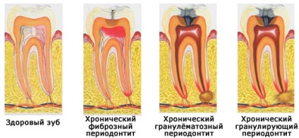 Parodontita cronică - enciclopedie a stomatologiei