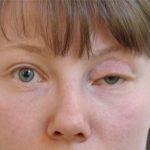 Zaditen (instrucțiuni privind picăturile oftalmice) privind utilizarea antihistaminicelor împotriva alergiilor, mâncărime