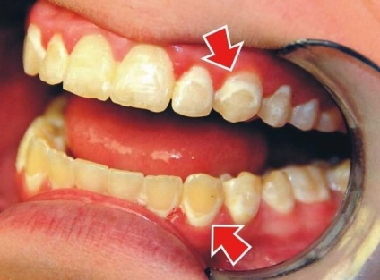 Pete galben pe dinți, cum să eliminați acoperirea galbenă pe dinți, albirea dinților acasă