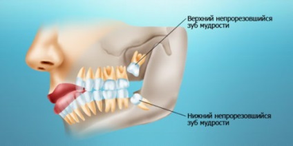 Dintele de înțelepciune crește în dinte, dacă se află pe orizontală