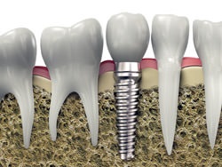 10 Întrebări de actualitate despre implantarea dentară