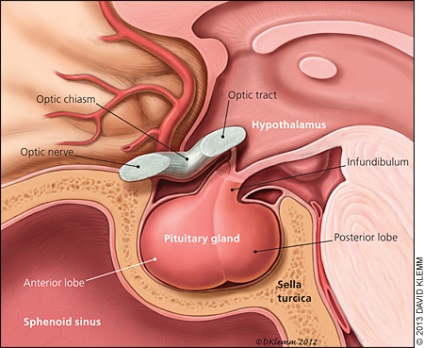 Adenomul pituitar