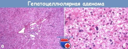 Adenomul hepatic