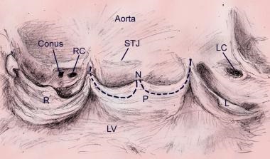 аортальний клапан