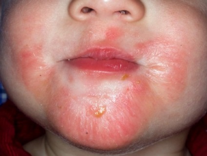 Атопичен дерматит при деца симптоми, причини и лечение