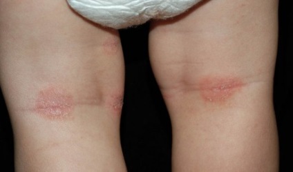 Atópiás dermatitis gyermekek tünetei, okai és kezelése