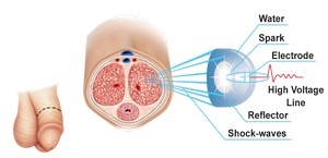 Boala Peyronie, centrul rezonanței terapiei cu valuri de șoc