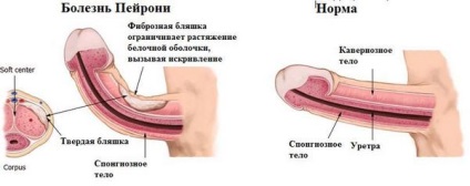 Boala Peyronie, centrul rezonanței terapiei cu valuri de șoc