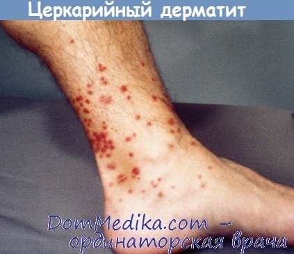 Cercaria dermatită - diagnostic, tratament