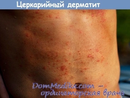 Cercaria dermatită - diagnostic, tratament