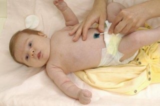 Ce trebuie să faceți dacă nou-născutul are ombilic