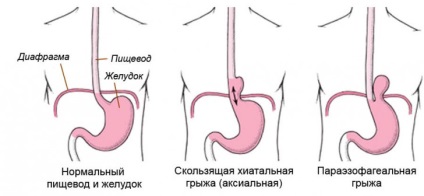 Rekeszsérv gyermekek és felnőttek, okok, tünetek, diagnózis, kezelés és