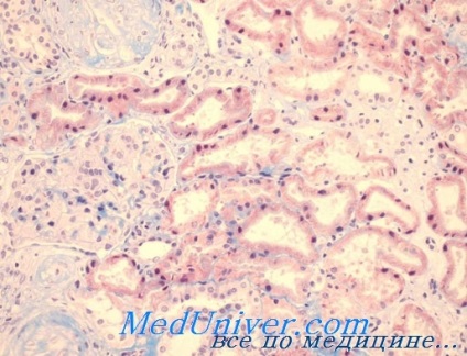 Diagnosticul și tratamentul sindromului hemolitic-uremic