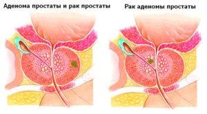 Diagnosticul cancerului de prostată la bărbați, un test pentru cancerul de prostată și modul în care arată studiul