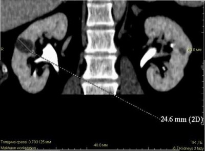 Benign tumorile renale și tratamentul neoplasmelor