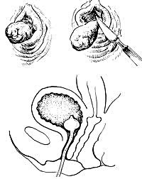 Tumorile benigne ale uretrei - cauze, simptome, diagnostic și tratament