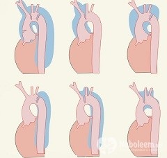 Arcul aortic - ramuri, structură, boli