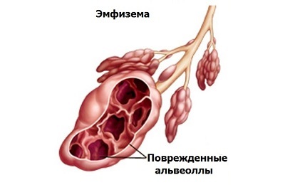 Az emphysema kezelése népi jogorvoslati otthon, légzőgyakorlatok és a táplálkozás