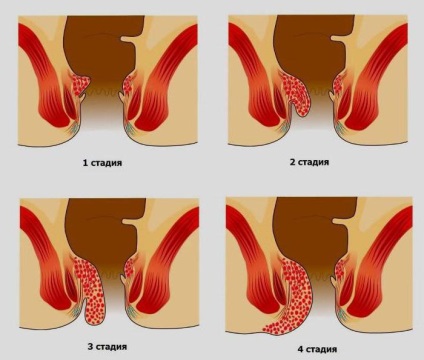 Hemoroizii pot trece prin etapele de dezvoltare și tratament
