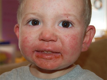 Herpesul pe față așa cum arată și ce metode sunt tratate