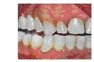Гнучкі нейлонові протези, стоматологічна поліклініка №5