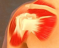 Gimnastica pentru artroza articulației umărului LPT, încărcare și un set de exerciții în tratamentul artritei umărului