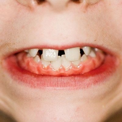 Dinți dinți la copii și adulți